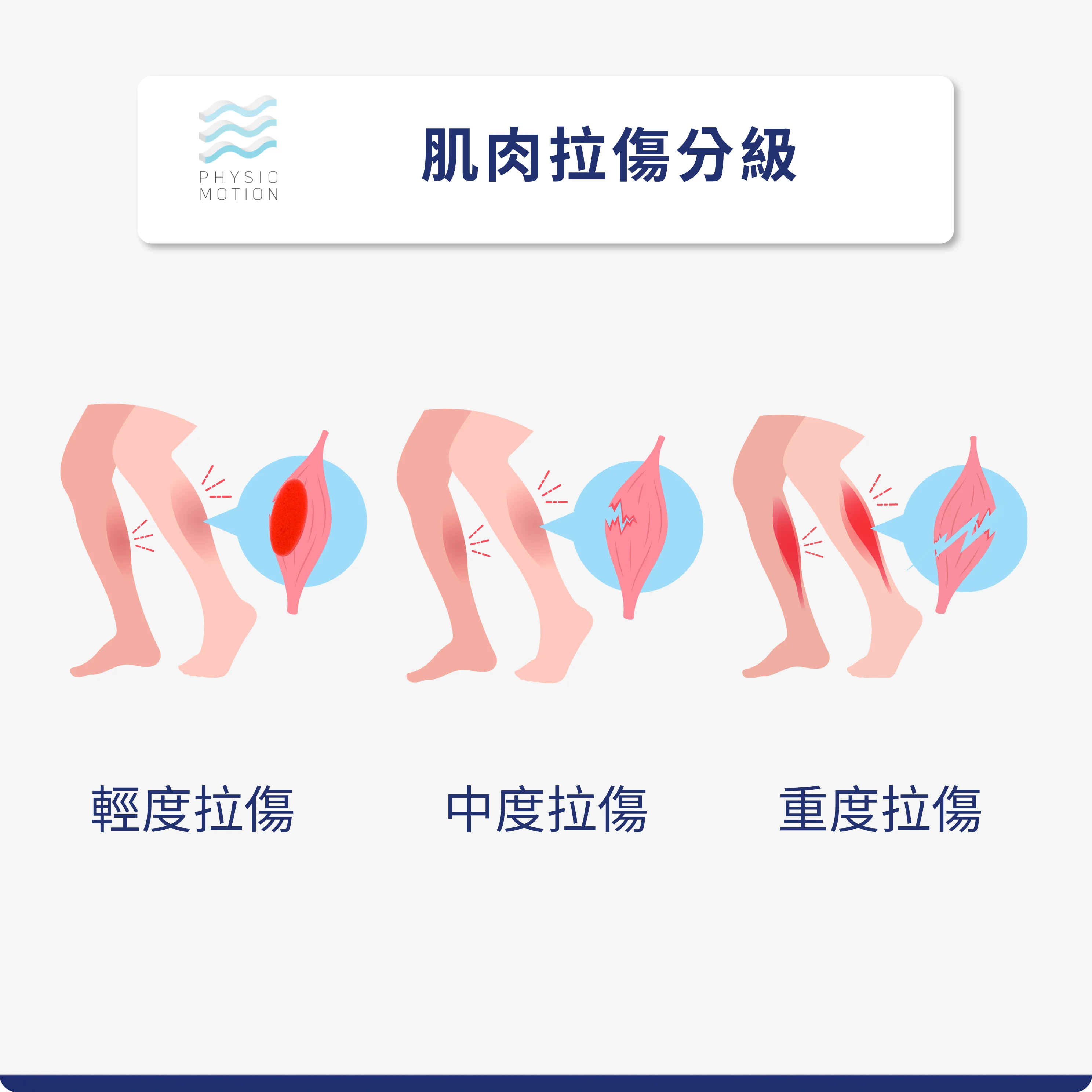 肌肉拉傷復健全攻略:物理治療師帶你從急性期走到完全恢復 1 肌肉拉傷分級