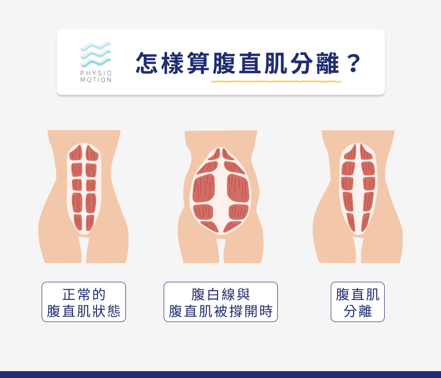 腹直肌分離怎麼辦?4種修復方法教你找回產前的最佳狀態! 1 5. 腹直肌分離 1