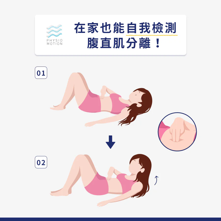 腹直肌分離怎麼辦?4種修復方法教你找回產前的最佳狀態! 2 5. 腹直肌分離 2
