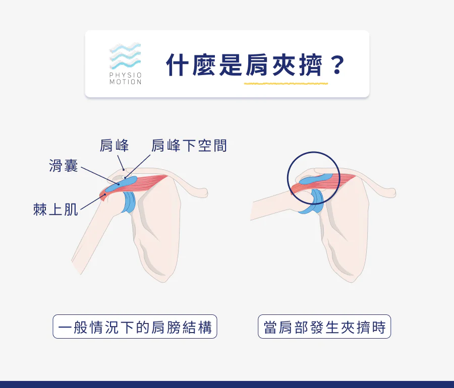 肩夾擠症候群是什麼?舉手會痛的原因可能不是五十肩而是肩夾擠! 1 6. 肩夾擠症候群 1